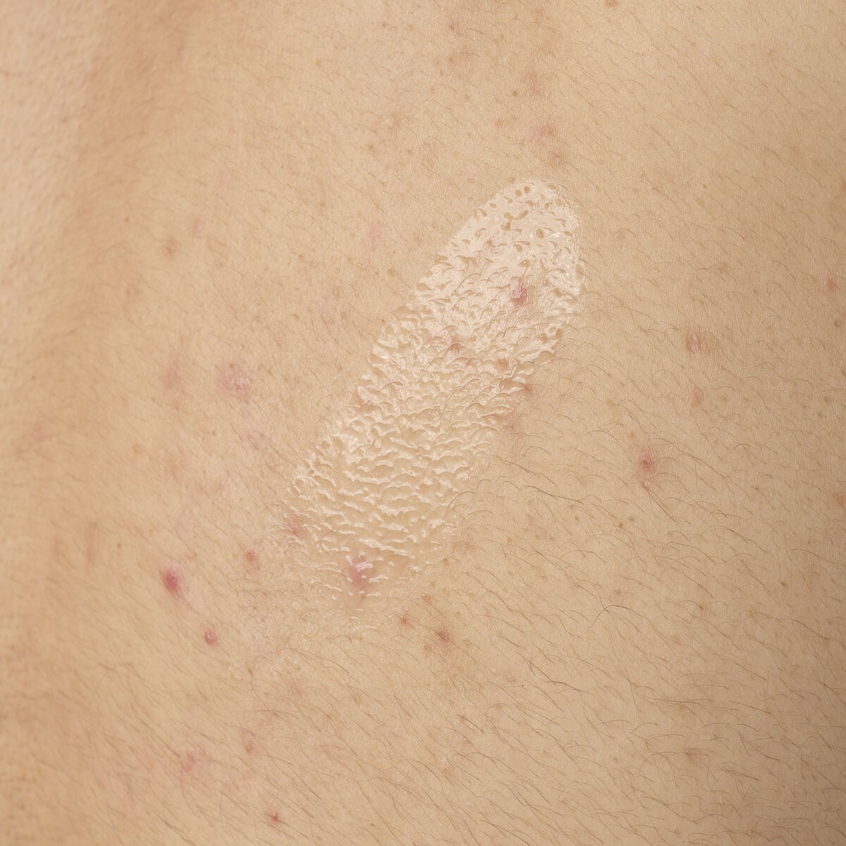 salicylic-acid-0-5-body-serum-d1 ORD-salicylic-acid-05-body-240ml-application.jpg