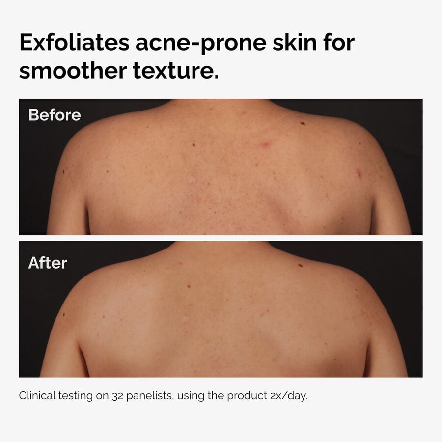 the-body-care-collection-t6 ord-salicylic-acid-body-serum-before-after-graphic-NA.jpg
