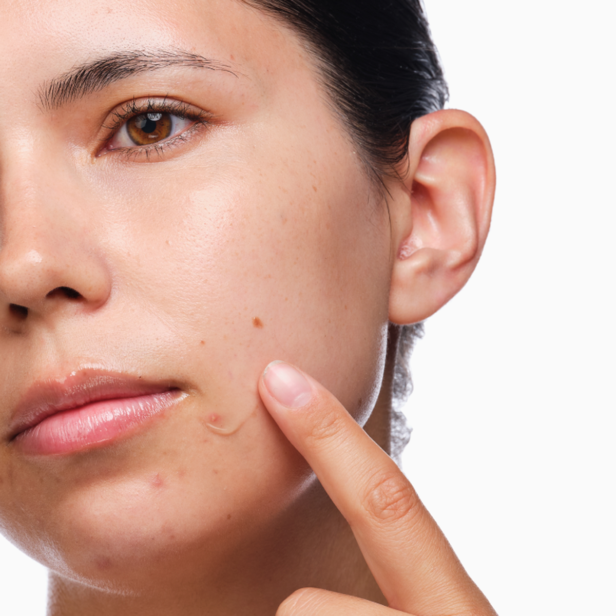 the-acne-set-r9 rdn-the-acne-set-application.png